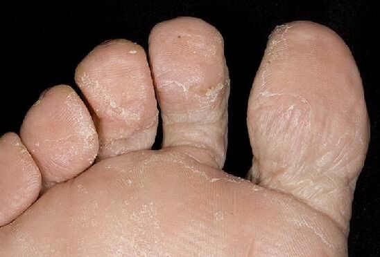 Candidiasis des Fußes