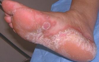 Akute Dermatomykose des Fußes