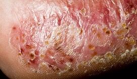 Dermatomykose