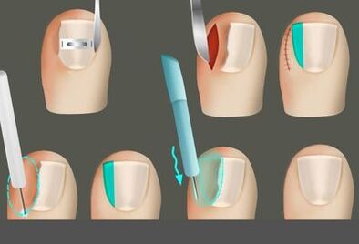 Entfernen des Nagels in Gegenwart eines Pilzes an den Beinen