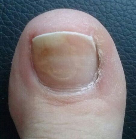 Der Nagelpilz am Daumen