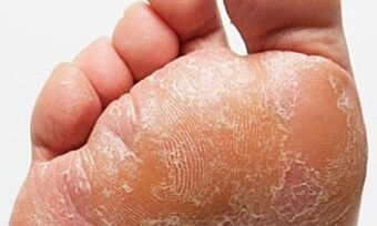 Anzeichen und Symptome von Pilz an den Beinen