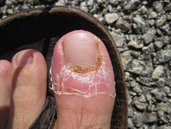 Schädigung der Nägel und der Haut der Zehen aufgrund einer Pilzinfektion